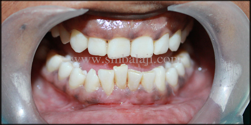 Dental Implants for Malaligned Mobile Teeth 1 1) Patient with malaligned lower front teeth
