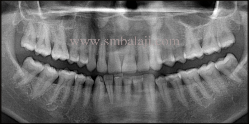Dental Implants for Malaligned Mobile Teeth 2 Pre-operative OPG shows bone loss at the relative site