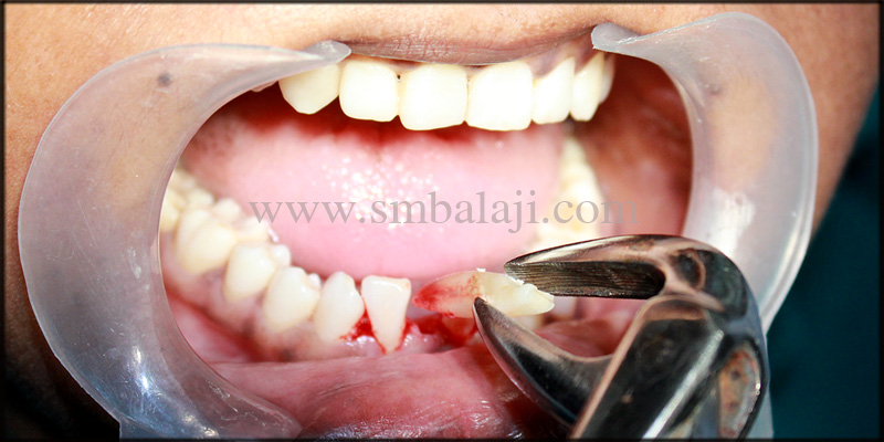 Dental Implants for Malaligned Mobile Teeth 3 Extraction of the mobile lower anteriors done under local anesthesia