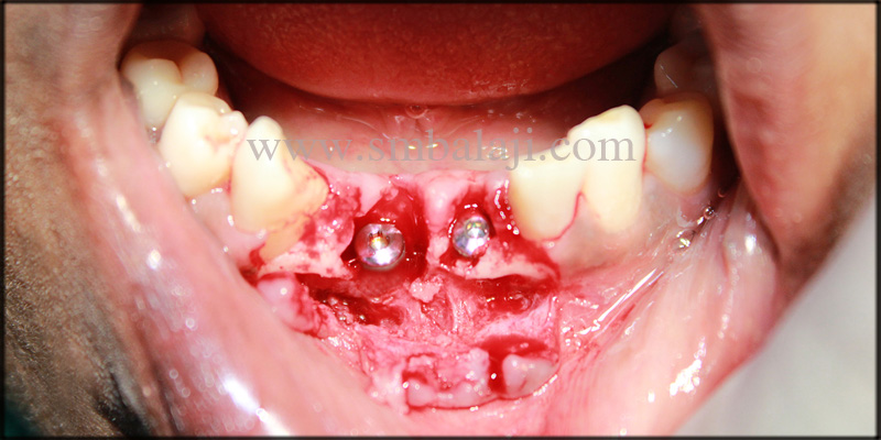 Dental Implants for Malaligned Mobile Teeth 4 Dental implants fixed in the underlying bone at the respective site