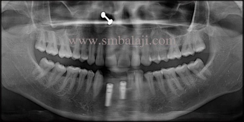 Dental Implants for Malaligned Mobile Teeth 5 Post-operative OPG shows well osseointegrated dental implants