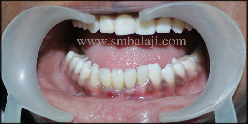 Dental Implants for Malaligned Mobile Teeth 6 Well aligned natural looking fixed prosthesis fulfilling the patients requirement