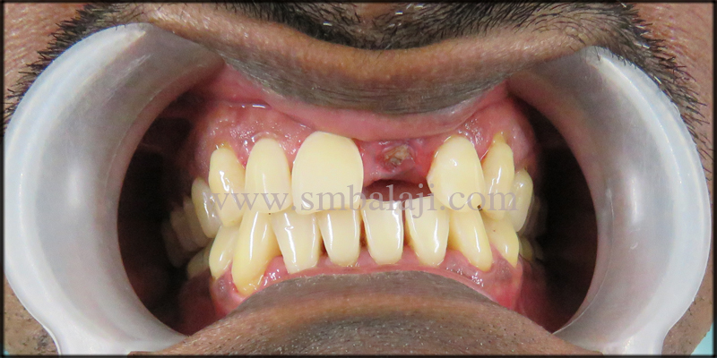 Replacement of broken root canal treated tooth with Dental Implant 1 Patient with broken upper front tooth