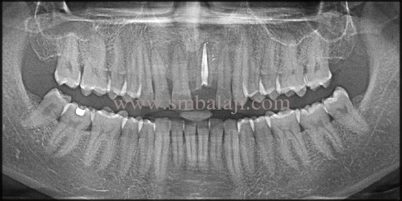 Replacement of broken root canal treated tooth with Dental Implant 2 Pre operative OPG shows root canal treated tooth
