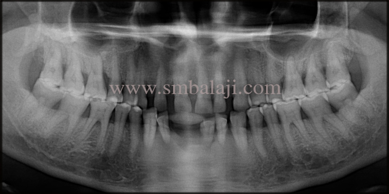 Replacement of compromised teeth and space closure with dental implants 2 Pre-operative OPG shows generalized bone loss in all teeth