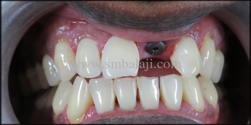 Replacement of broken root canal treated tooth with Dental Implant 3 Dental implants placed directly into the jaw bone