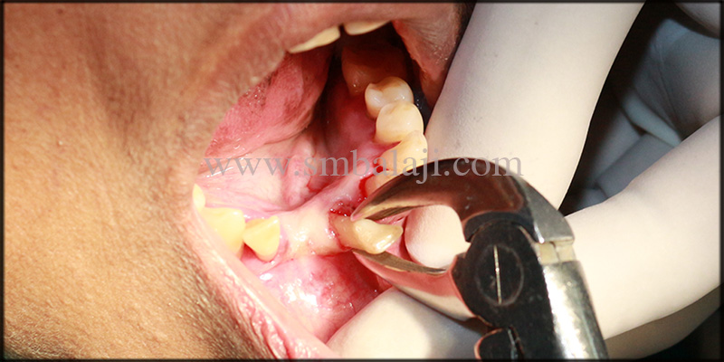 Replacement of compromised teeth and space closure with dental implants 3 Extraction of the mobile lower front teeth under local anesthesia