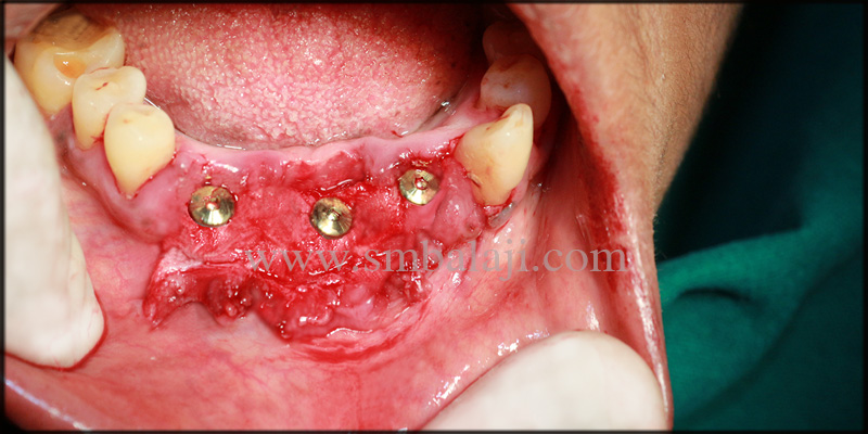Replacement of compromised teeth and space closure with dental implants 4 Dental implants fixed at the relative site with stability