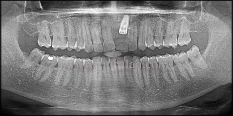 Replacement of broken root canal treated tooth with Dental Implant 4 Post-operative OPG shows osseointegrated dental implant