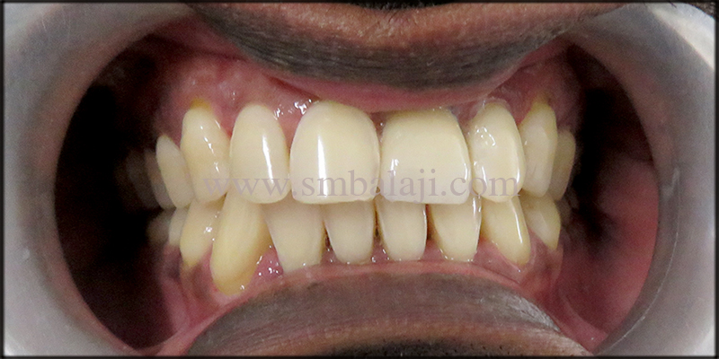 Replacement of broken root canal treated tooth with Dental Implant 5 Natural looking prosthesis fixed onto the dental implant
