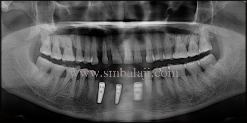 Replacement of compromised teeth and space closure with dental implants 5 Post- operative OPG shows well osseointegrated dental implant