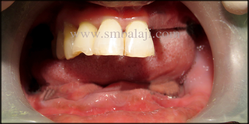 Oral Rehabilitation with Dental Implants 1 Patient with missing teeth in the upper and lower jaw