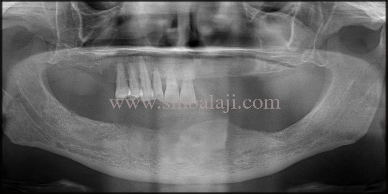 Oral Rehabilitation with Dental Implants 2 OPG taken shows missing teeth with sufficient bone height for dental implant placement