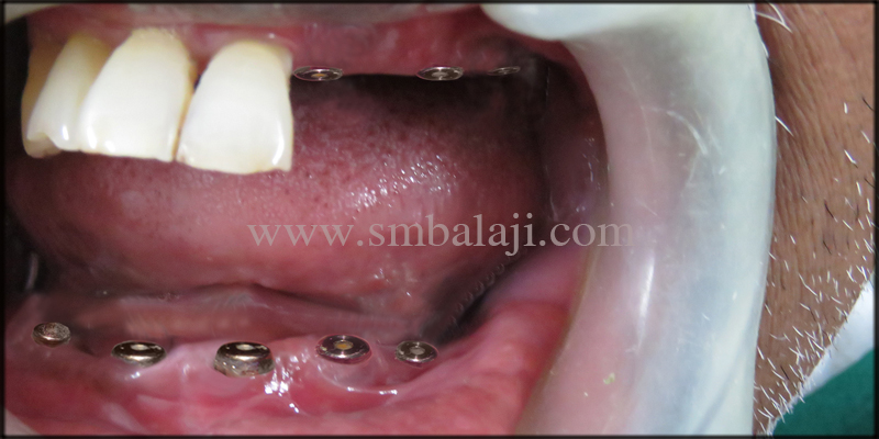 Oral Rehabilitation with Dental Implants 3 Dental implants placed at the relative site in the upper and lower jaw
