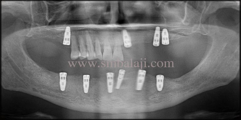 Oral Rehabilitation with Dental Implants 4 Post- operative OPG taken shows dental implants well integrated with the underlying jaw bone
