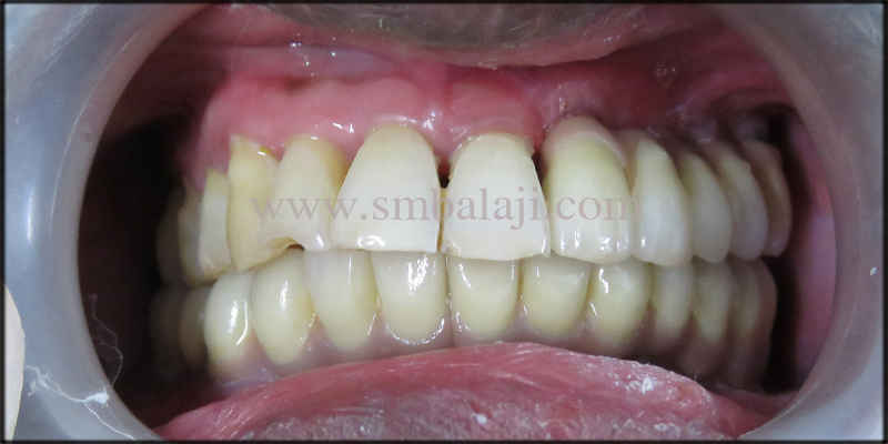 Oral Rehabilitation with Dental Implants 5 Natural looking fixed ceramic prosthesis placed onto the dental implants