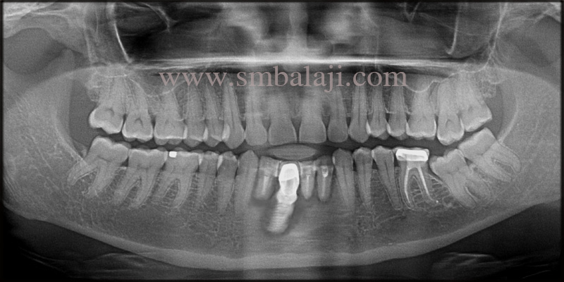 Infected Mobile Teeth Replaced With Dental Implants 1 Pre-operative OPG shows root canal treated lower anteriors and infected dental implant