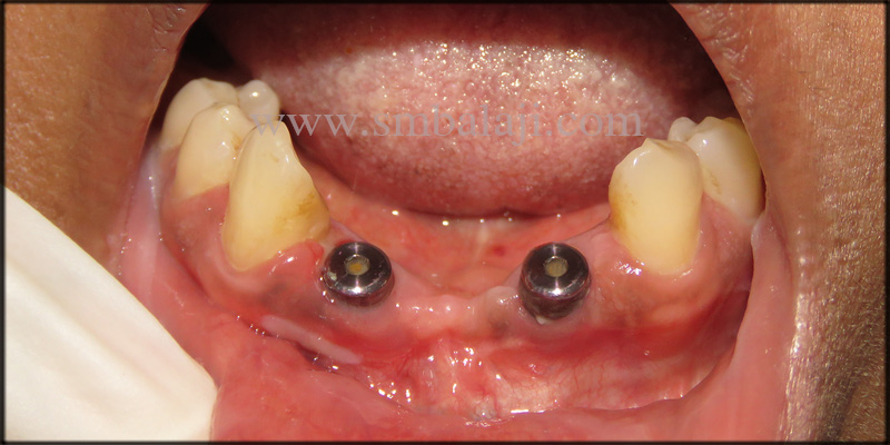 Infected Mobile Teeth Replaced With Dental Implants 2 Dental implants of perfect size and height fixed in the jaw bone at the involved site