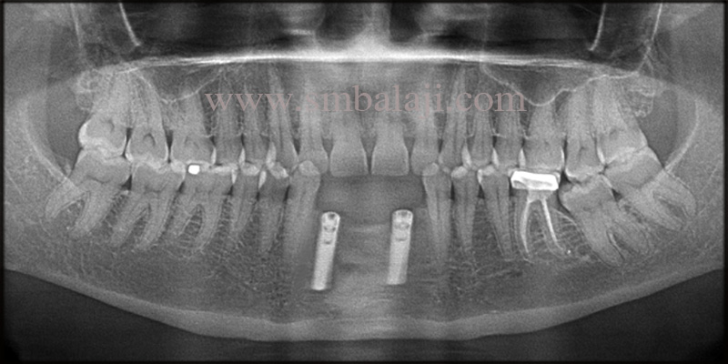 Infected Mobile Teeth Replaced With Dental Implants 3 Post operative OPG shows well osseointegrated dental implants