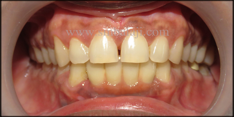 Infected Mobile Teeth Replaced With Dental Implants 4 Natural looking prosthesis fixed onto the dental implants