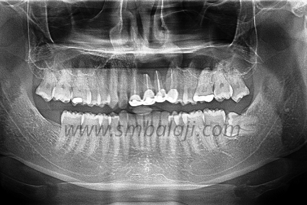 Upper Jaw Reconstruction with Rib Graft and Dental Implants