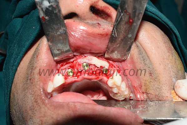 Upper Jaw Reconstruction with Rib Graft and Dental Implants
