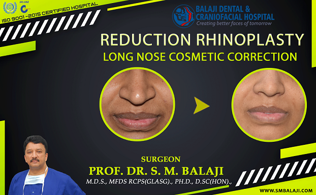 Reduction Rhinoplasty –  Long Nose Cosmetic Correction