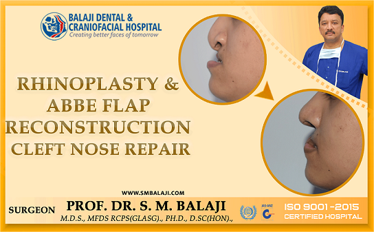 Rhinoplasty and Abbe Flap Reconstruction – Cleft Nose Repair