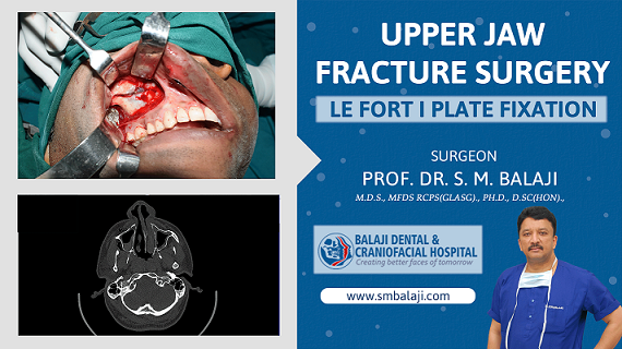 Upper jaw Fracture Surgery – Le Fort I Plate Fixation