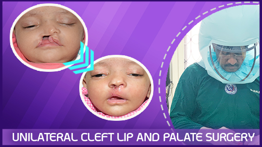 Unilateral Cleft Lip and Palate with Wide Gap and Very Small Minor Segment