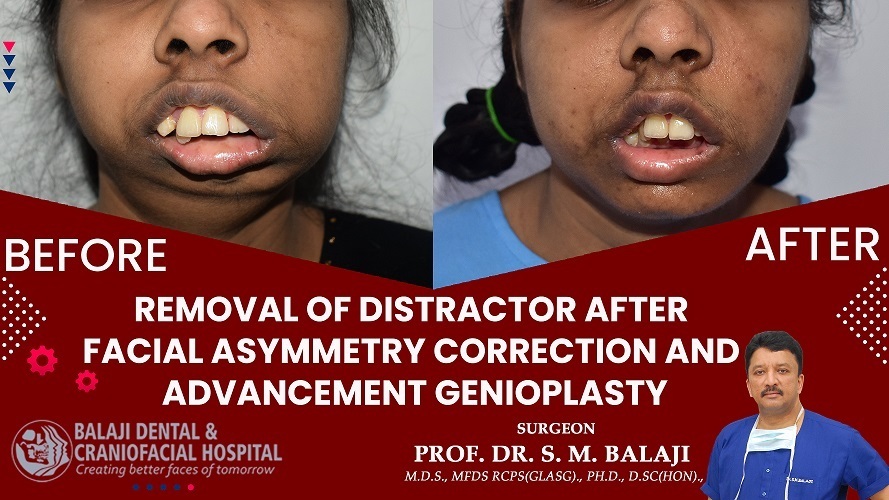 Removal of Distractor after Facial Asymmetry Correction and Advancement Genioplasty